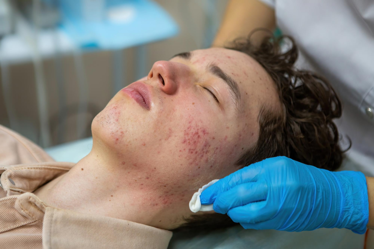 Acne Scars Treatments in de Felipe