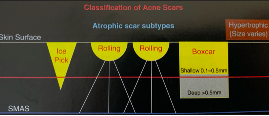 Subsicion acne scars