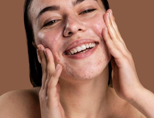Why does acne appear? Here are some of the most common causes