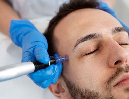 Microneedling: Is it for all patients?