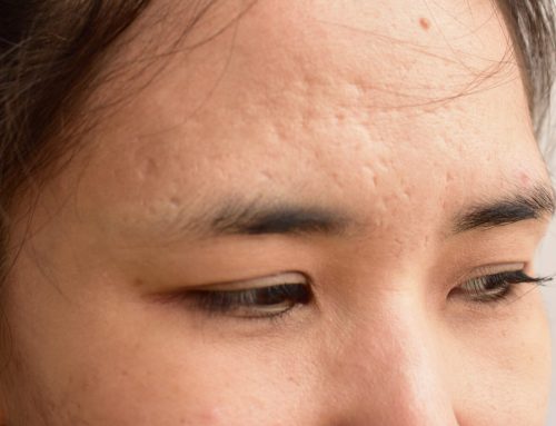 Calcium hydroxyapatite: An effective treatment for atrophic scarring in summer