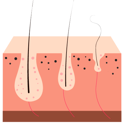 causas-alopecia