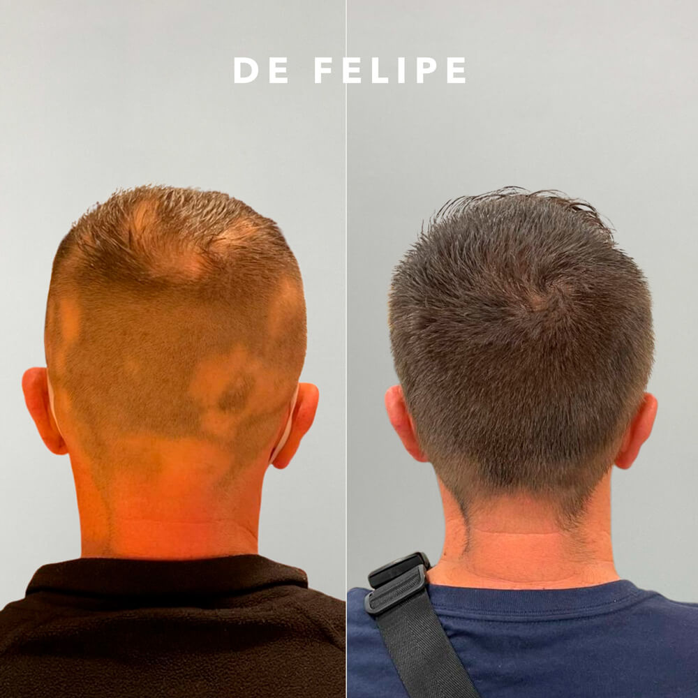 tricology_A-D_ES-PELO003