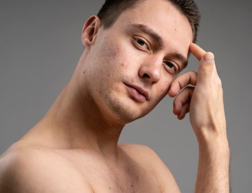 Adult Acne After 30: Why It Happens and How to Treat It Effectively