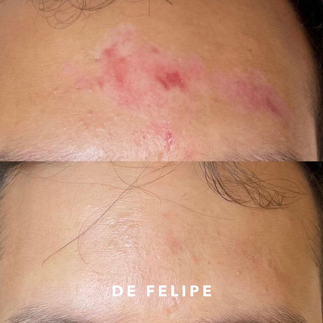 AD – Cicatrices-2