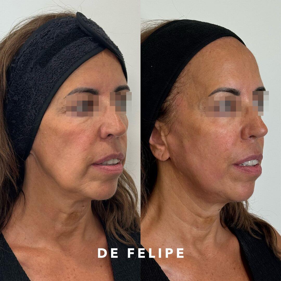 AD – DE – Hilos