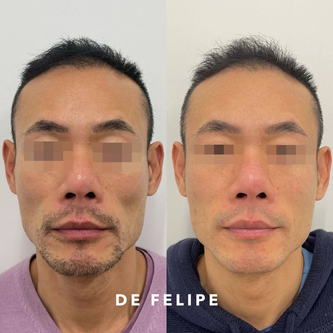 AD – MR – Sculptra
